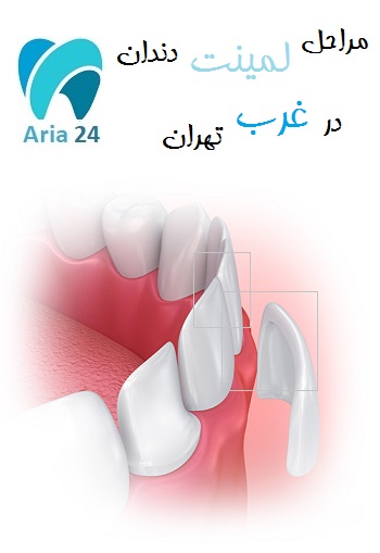 مراحل لمینت دندان در غرب تهران