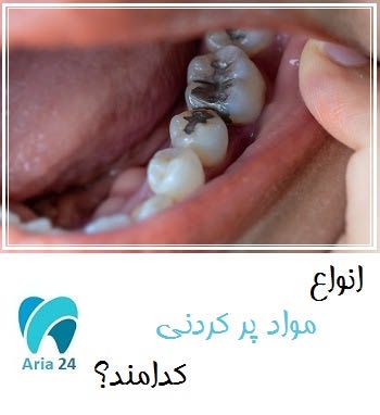 انواع مواد پر کردنی دندان