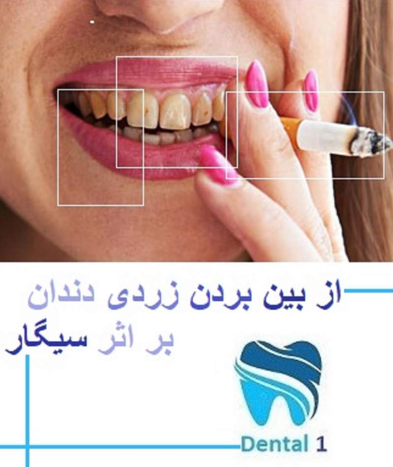 از بین بردن زردی دندان بر اثر سیگار