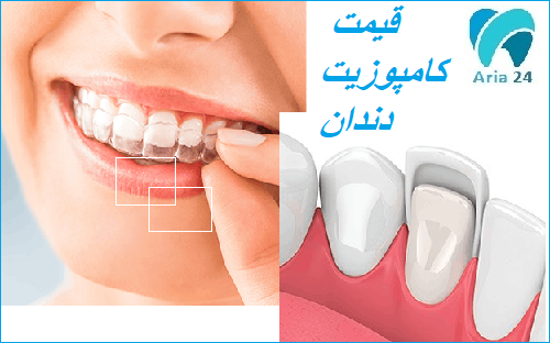 قیمت کامپوزیت دندان  در سال1402