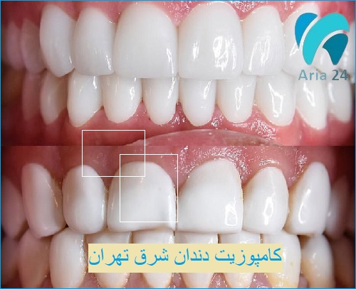 کامپوزیت دندان شرق تهران